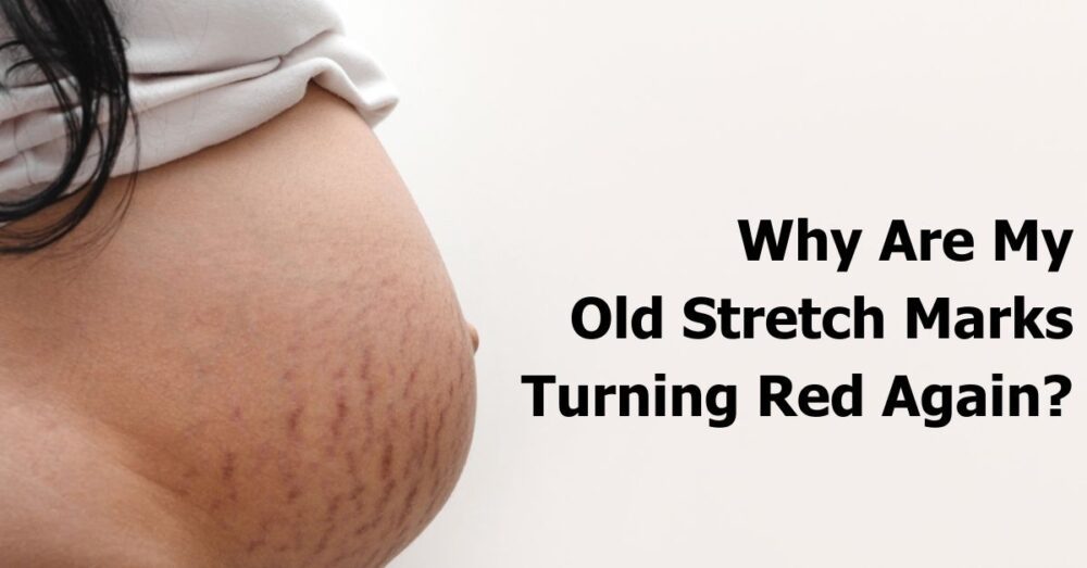Why Are My Old Stretch Marks Turning Red Again & What To Do