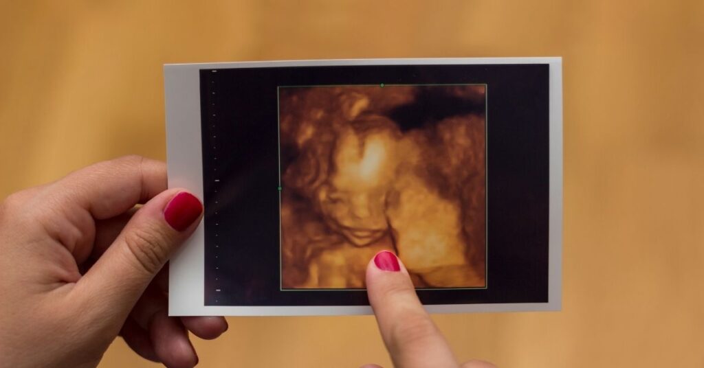 why do babies lips look big in ultrasound (featured)