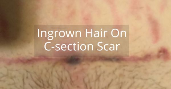 ingrown hair on c section scar