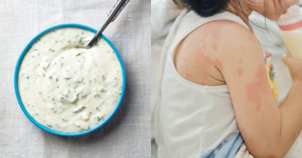 toddler skin reaction to ranch dressing