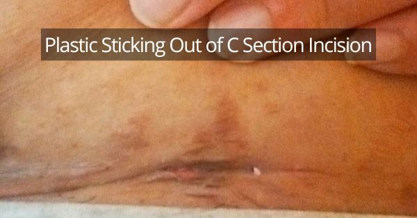 plastic sticking out of c section incision
