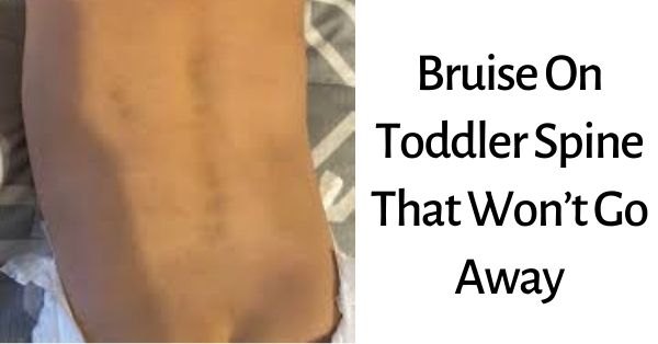 Bruise On Toddler Spine That Won’t Go Away