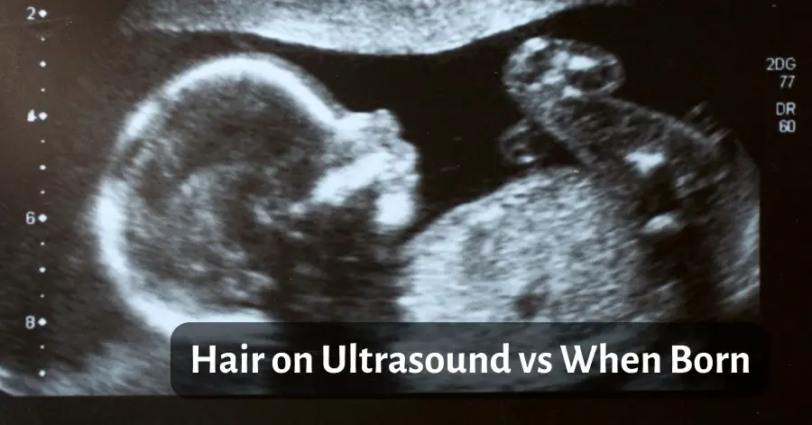 Hair on Ultrasound vs When Born