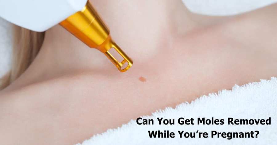 Can You Get Moles Removed While Pregnant