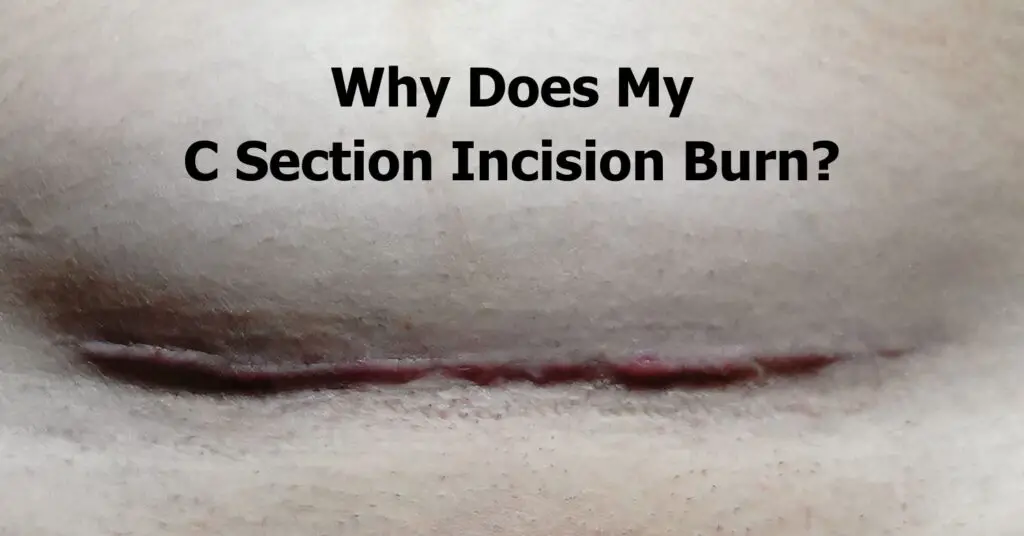 Why Does My C Section Incision Burn