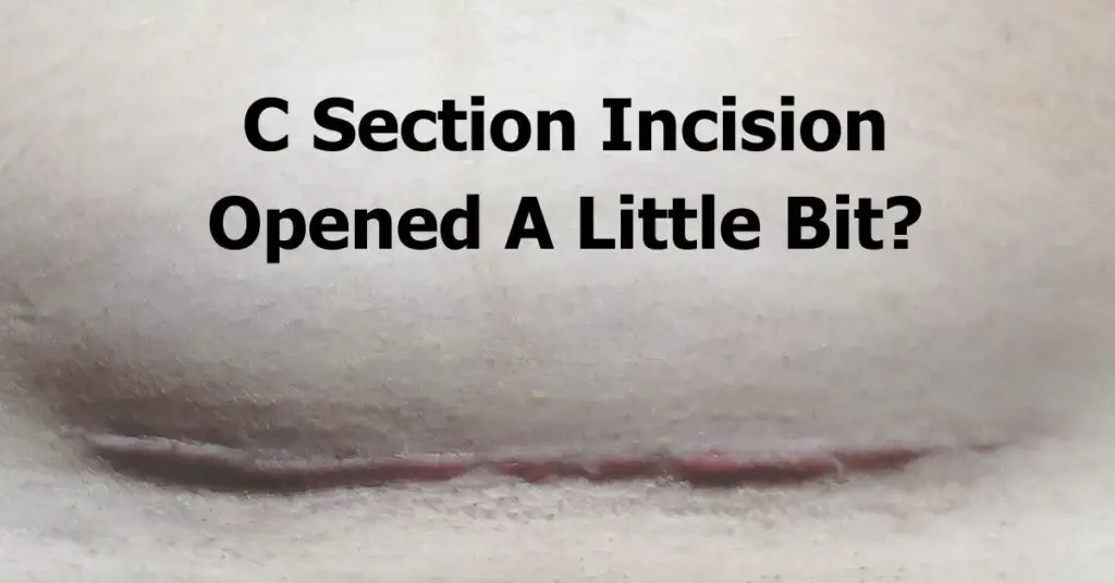 C Section Incision Opened A Little