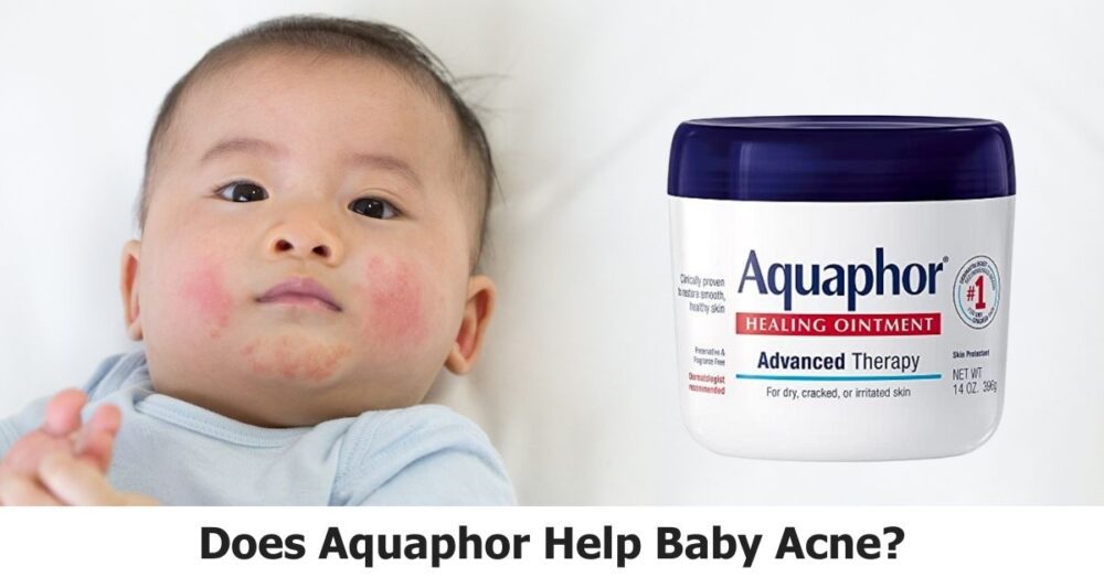 Does Aquaphor Help Baby Acne? Aquaphor's Magic On Baby Face 👶