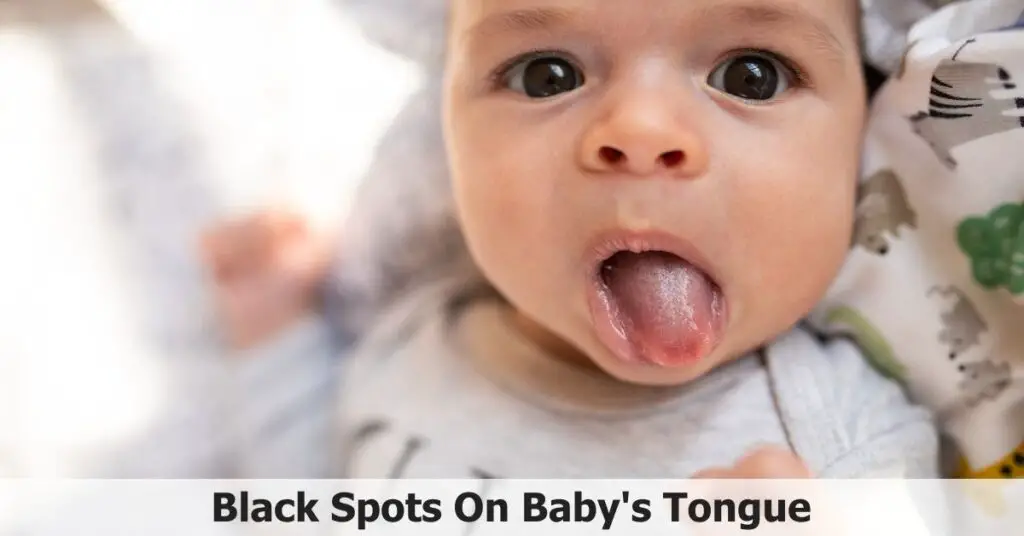 Black Spots On Baby's Tongue