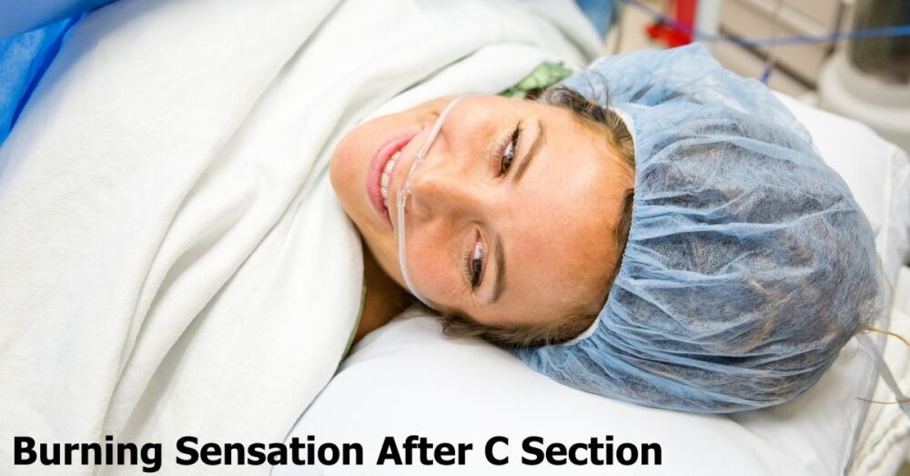 burning sensation in stretch marks after c section