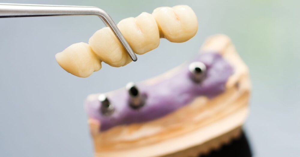 Can I Have An Mri With A Dental Bridge? Expert Guidance