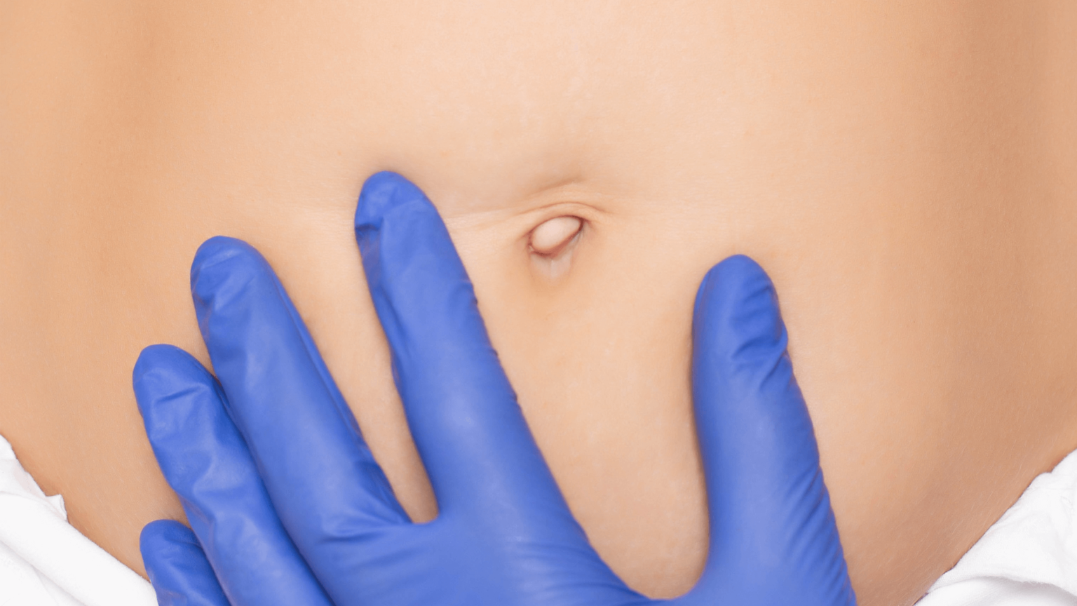 How Common Are Outie Belly Buttons? Understanding Belly Button Shapes