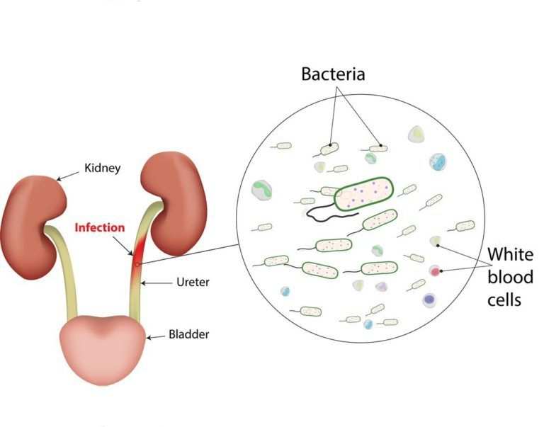 urinary tract infection