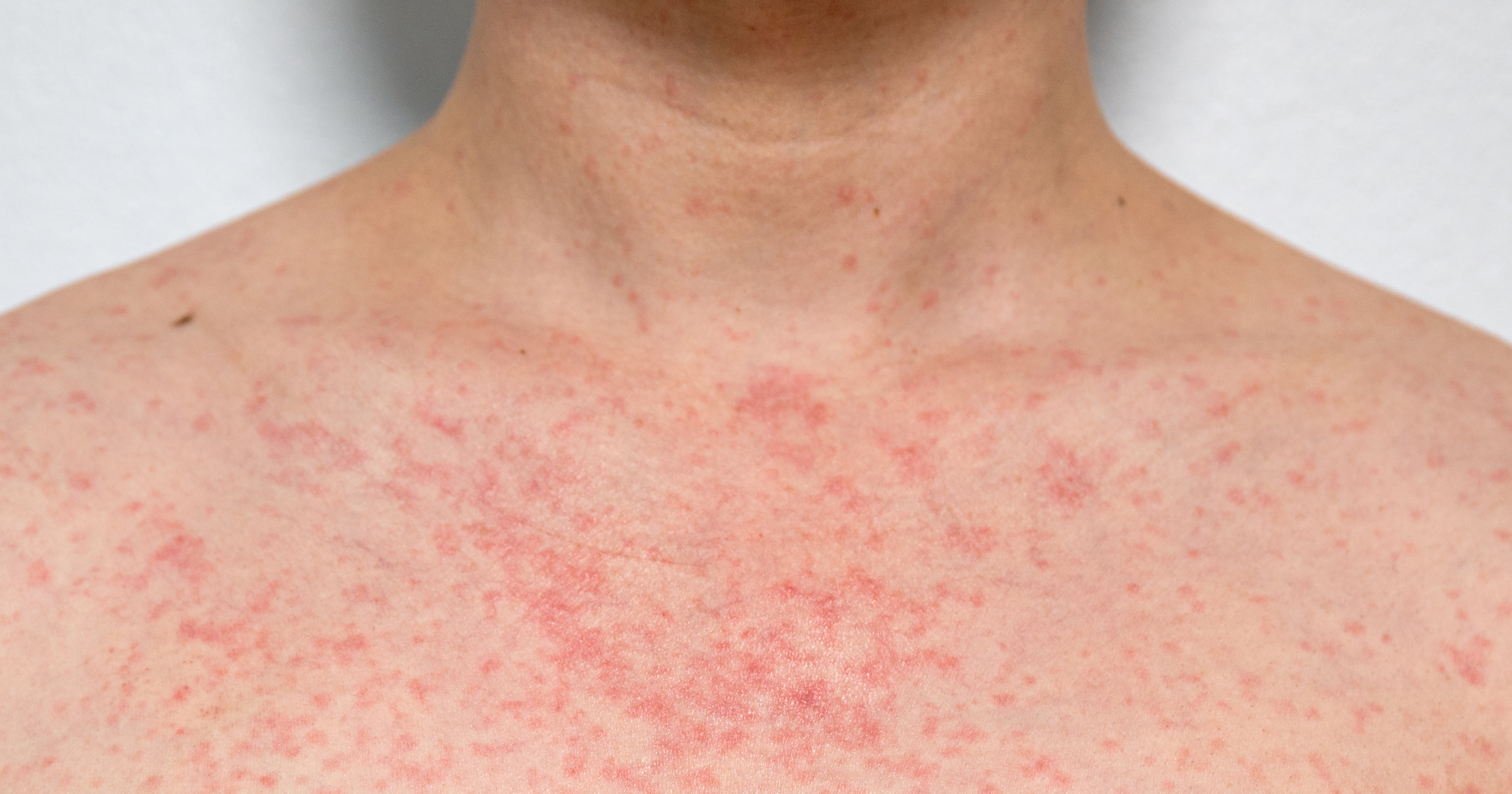 Is This Oxalate Rash?  See Disturbing Pictures & Learn More - ew97aqr