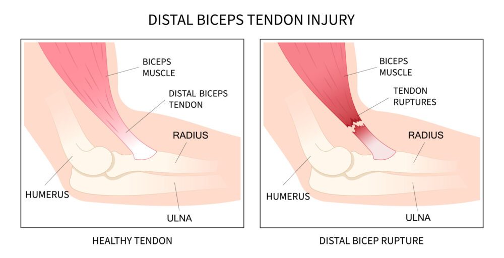 Will Tendon Tear Heal Itself? | Healing Insights